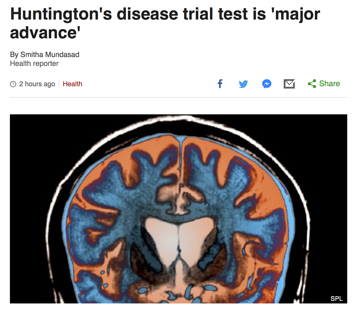 BBC News – Huntington’s Disease Trial Test Is ‘major Advance ...